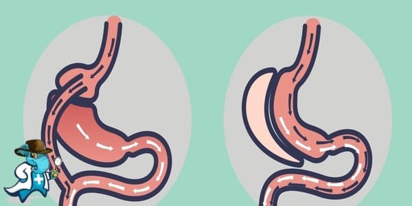 ¿Cuál es el Periodo de Carencia de un Seguro de Salud Para Cirugía Bariátrica en España?