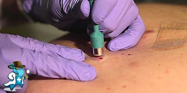 ¿Cuánto Cuesta un Seguro de Salud que Cubra la Biopsia Cutánea en España?