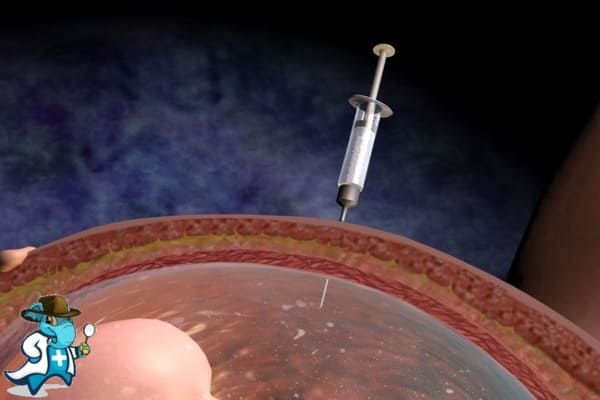 ¿Cubre el Seguro de Salud la Biopsia Corial en España?