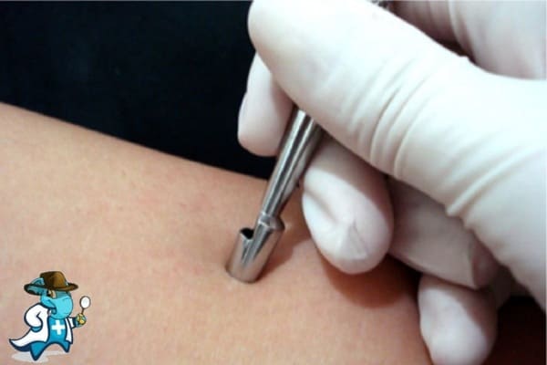 ¿Qué Periodo de Carencia Tiene un Seguro de Salud que Cubra la Biopsia Cutánea en España?