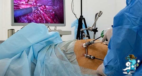 Qué Periodo de Carencia Tiene un Seguro de Salud que Cubra la Laparoscopia en España