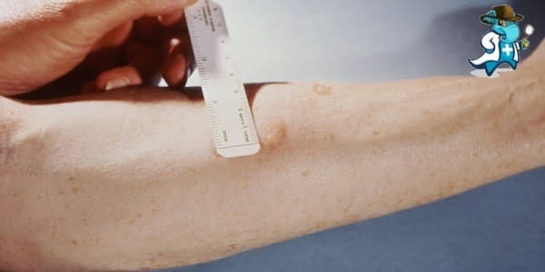 Qué Periodo de Carencia Tiene un Seguro de Salud que Cubra la Mantoux o Prueba de la Tuberculina en España