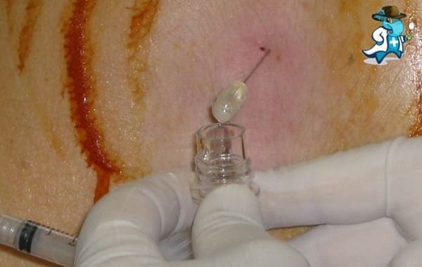 Qué periodo de Carencia tiene un Seguro de Salud que cubra la Punción Lumbar en España