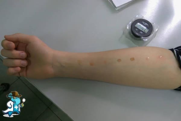 ¿Cuánto Cuesta un Seguro de Salud que Cubra el Prick Test o las Pruebas Cutáneas de Alergia en España?
