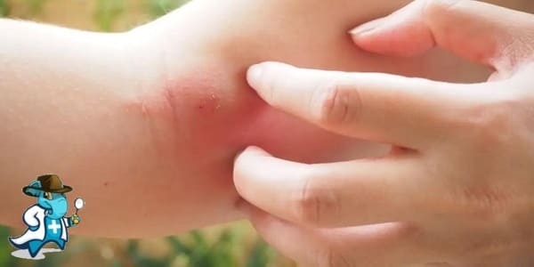¿Me Cubre el Seguro de Salud las Picaduras de Insectos en España?