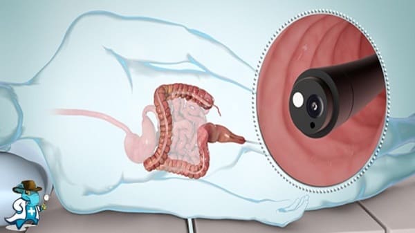 ¿Qué Periodo de Carencia Tiene un Seguro de Salud que Cubra Sigmoidoscopia en España?