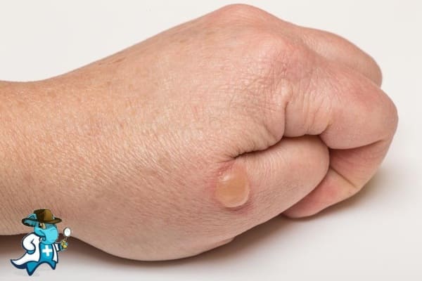¿Qué Periodo de Carencia Tiene un Seguro de Salud que Cubra las Ampollas en España?