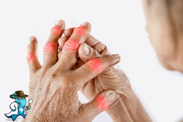 ¿Puedo Contratar un Seguro de Salud si Tengo Artritis Reumatoide en España?