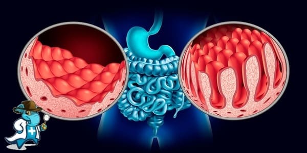 ¿Puedo Ocultar que Tengo Celiaquía Para Contratar el Seguro de Salud en España?