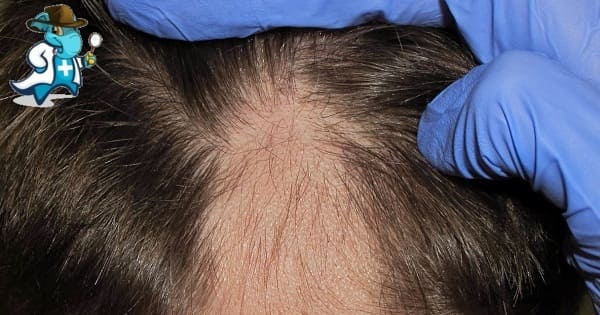 Qué Periodo de Carencia Tiene un Seguro de Salud que Cubra la Prueba o Test del Lavado Capilar en España