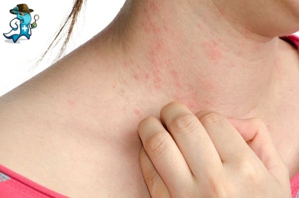 Aumenta el Precio del Seguro de Salud Para una Persona con Alergia al Huevo en España