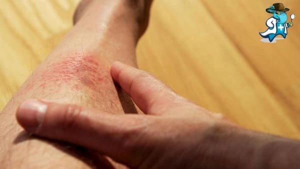 Aumenta el Precio del Seguro de Salud Para una Persona con una Alergia a la Avena en España