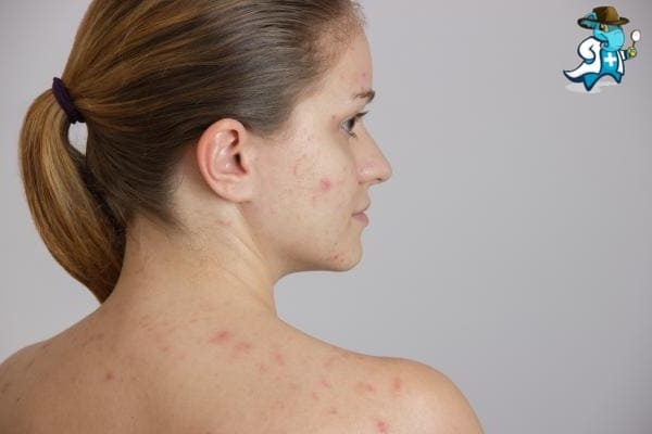 Aumenta el Precio del Seguro de Salud Para una Persona con una Alergia a los Cacahuetes en España