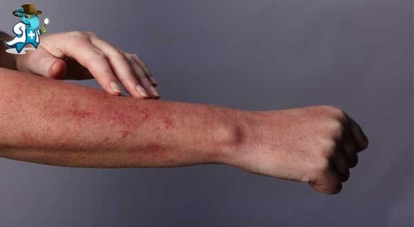 Aumenta el Precio del Seguro de Salud Para una Persona con una Alergia al Trigo en España