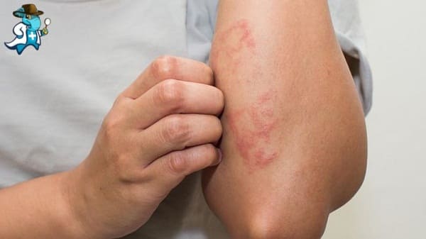 Cubre el Seguro de Salud la Alergia a la Cebada en España