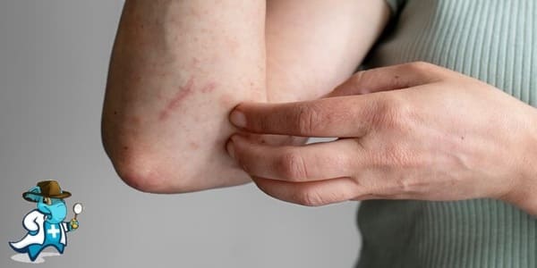 ¿Cubre el Seguro de Salud la Alergia al Níquel en España?
