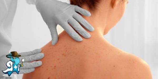 ¿Cubre el Seguro de Salud la Alergia al Sol en España?
