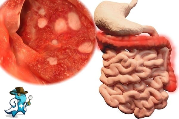 ¿Puedo Contratar un Seguro de Salud si Tengo Colitis Ulcerosa en España?