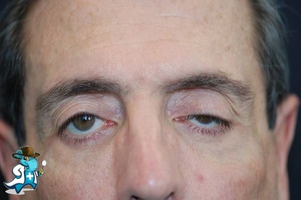 ¿Puedo Contratar un Seguro de Salud si Tengo Miastenia Gravis en España?