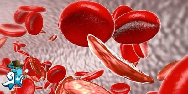 ¿Puedo Ocultar que Tengo la Anemia Perniciosa Para Contratar el Seguro de Salud en España?