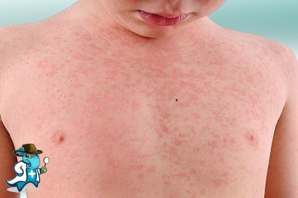 ¿Qué Exclusiones Tendría un Seguro de Salud Para un Niño con una Alergia en España?