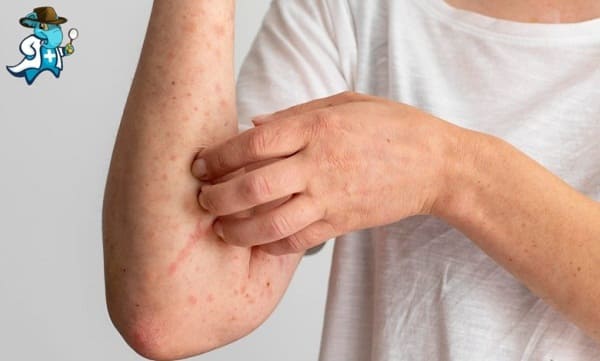 Qué Exclusiones Tendría un Seguro de Salud Para una Persona con Alergia al Huevo en España