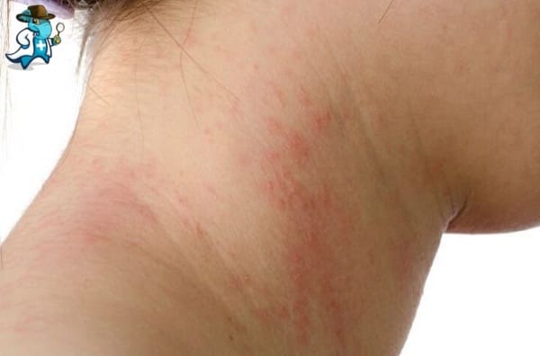 Qué Exclusiones Tendría un Seguro de Salud Para una Persona con una Alergia a la Cebada en España