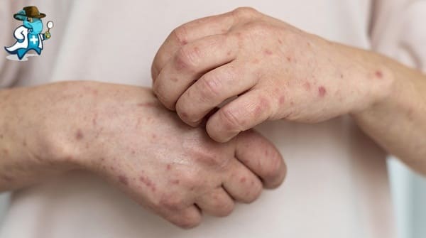 Qué Exclusiones Tendría un Seguro de Salud Para una Persona con una Alergia a los Albaricoques en España