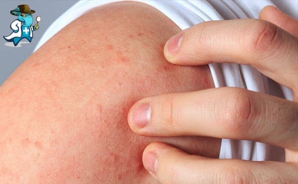 Qué Exclusiones Tendría un Seguro de Salud Para una Persona con una Alergia al Centeno en España