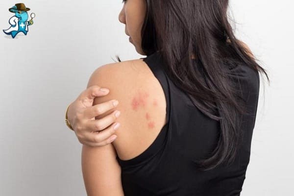 Qué Exclusiones Tendría un Seguro de Salud Para una Persona con una Alergia al Trigo en España