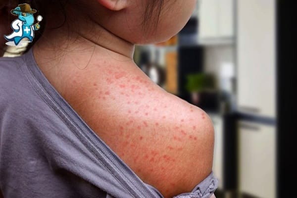 Aumenta el Precio del Seguro de Salud Para una Persona con Sarpullido en España