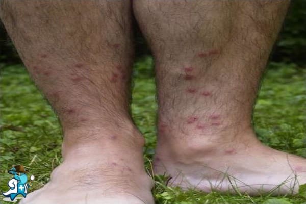 ¿Cubre el Seguro de Salud la Esquistosomiasis en España?
