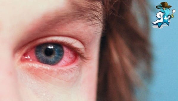 Qué Exclusiones Tendría un Seguro de Salud Para una Persona con una Conjuntivitis Alérgica en España