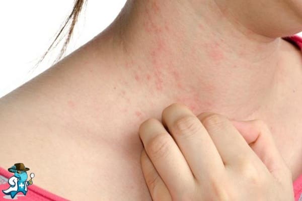 ¿Qué Exclusiones tendrían un Seguro de Salud para una Persona con una Alergia al vino en España?