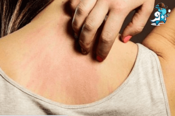 Qué exclusiones tendría un seguro de salud para una persona con una alergia al Detergente de ropa en España