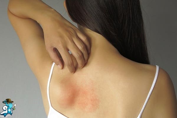 ¿Cubre el Seguro de Salud la Alergia al Tacto en España?