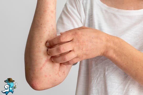 ¿Qué Exclusiones tendría un Seguro de Salud para una Persona con una Dermatitis Serpiginosa en España?